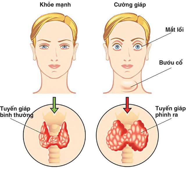 11 dấu hiệu cảnh báo bệnh lý tuyến giáp – CDC An Giang