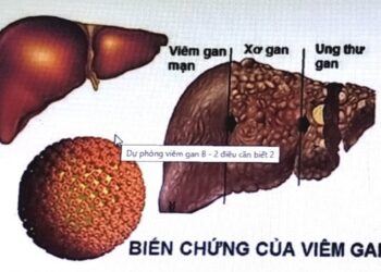 Virus viêm gan B – kẻ giết người thầm lặng