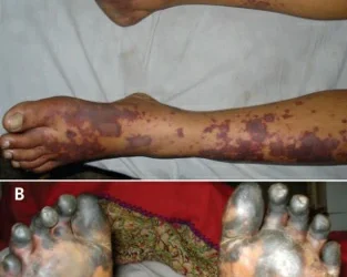 Những điều cần biết về bệnh do não mô cầu