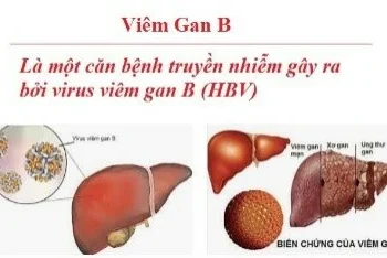 Viêm gan do vi rút – kẻ giết người thầm lặng
