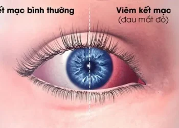 Phòng bệnh đau mắt đỏ