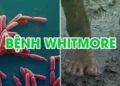 Cảnh báo nguy cơ lây nhiễm bệnh Whitmore: khuyến cáo chủ động phòng ngừa trước diễn biến phức tạp