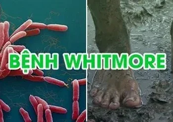 Cảnh báo nguy cơ lây nhiễm bệnh Whitmore: khuyến cáo chủ động phòng ngừa trước diễn biến phức tạp