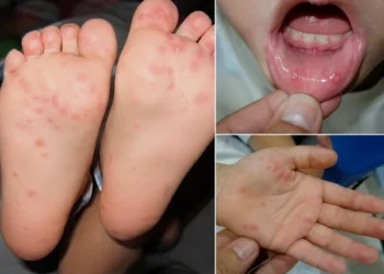 Tay Chân Miệng – đừng chủ quan với “bệnh nhẹ” ở trẻ nhỏ !