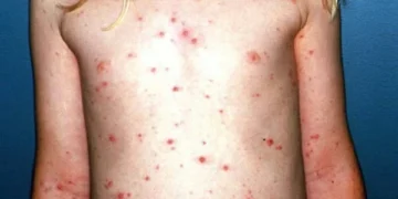 Bệnh Thủy đậu và cách phòng, tránh