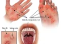 Đừng để sự chủ quan đánh đổi sức khỏe của trẻ trước bệnh Tay Chân Miệng