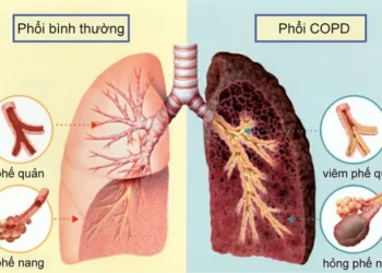 Bệnh phổi tắc nghẽn mãn tính – COPD