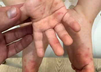 Không chủ quan với bệnh Tay Chân Miệng – chủ động phòng bệnh cho trẻ